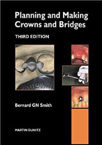 Planning and Making Crown And Bridge