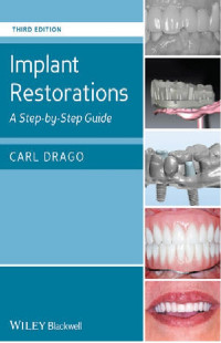 Implant Restorations A Step-by-Step Guide