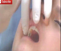 Pemasangan Behel Gigi atau Kawat Gigi behel